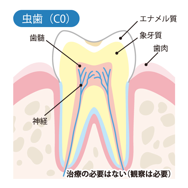 溝の口（川崎市高津区）の歯医者、小川歯科クリニックの、むし歯治療