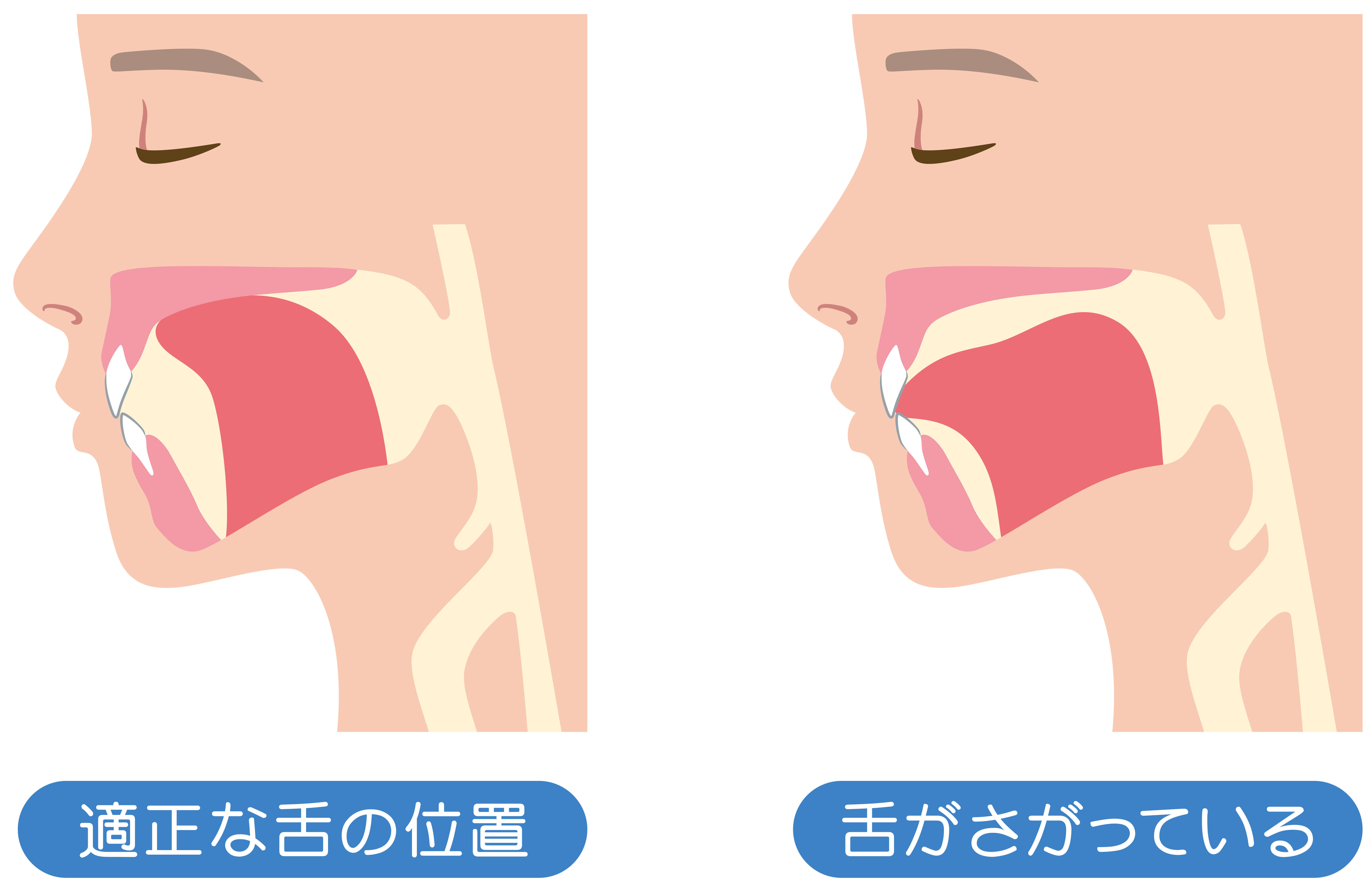 溝の口（川崎市高津区）の歯医者、小川歯科クリニックの、歯ぎしり・食いしばり